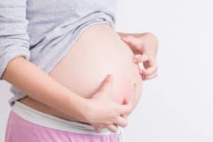 puppp pregnancy rash