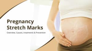Pregnancy Stretch Marks Causes, Prevention, and Treatment