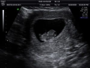 Baby Ultrasound Picture
