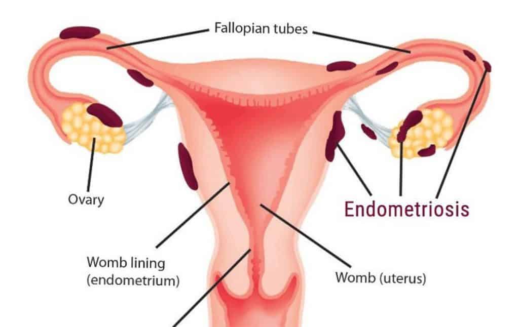 Getting Pregnant With Endometriosis naturally