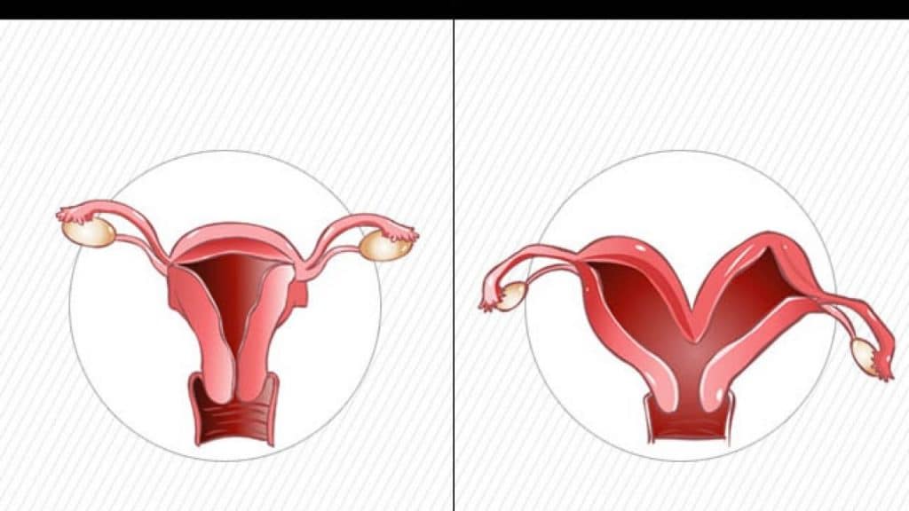 Pregnancy In Bicornuate Uterus