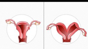 Pregnancy In Bicornuate Uterus