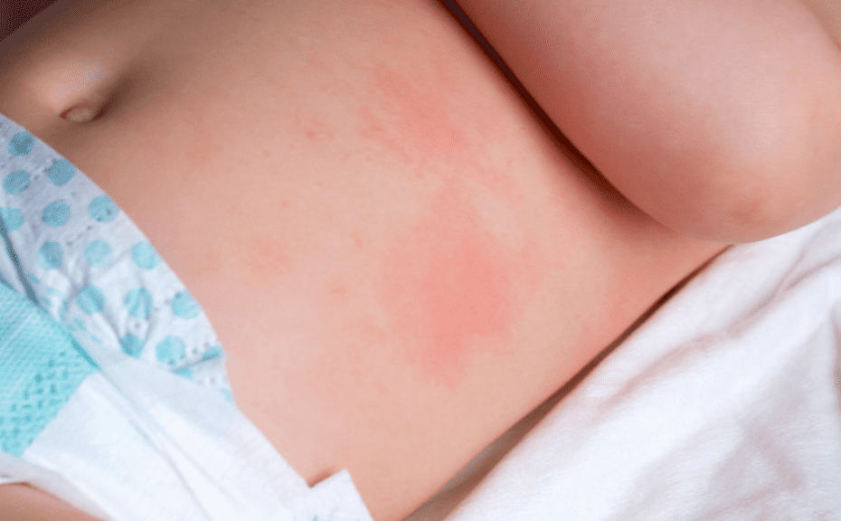 What foods are the most likely to induce allergic reactions in infants? Does my baby have a food allergy rash on the belly? How do you prevent them?