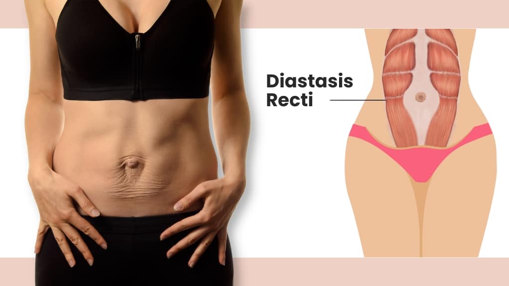 What Is Diastasis Recti Or Abdominal Separation