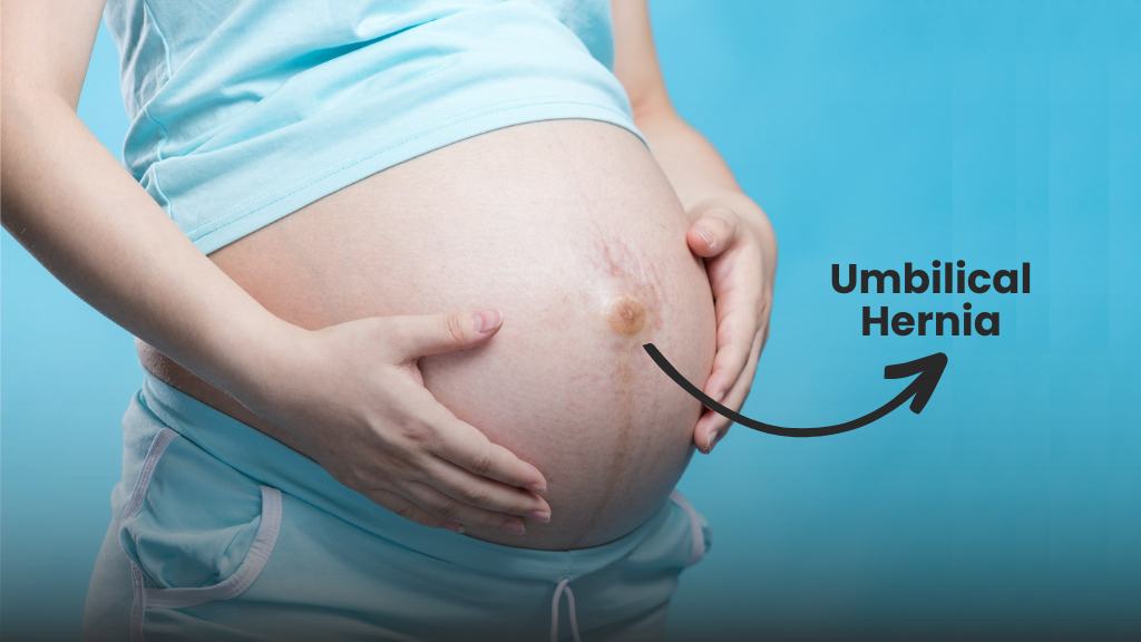 Umbilical Hernia