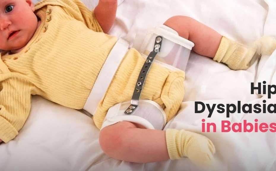 hip dysplasia in babies