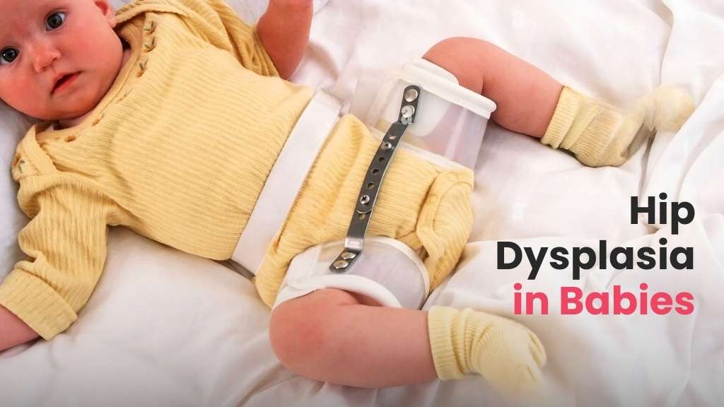 hip dysplasia in babies