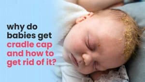why do babies get cradle cap and how to get rid of Cradle cap